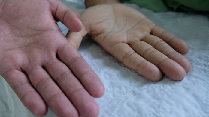 Eine Hand mit normaler Durchblutung, zweite Hand mit Anämie