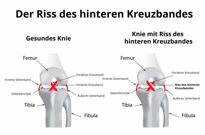 Riss des hinteren Kreuzbandes