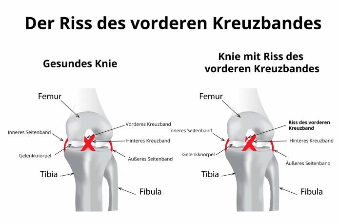 Riss des vorderen Kreuzbandes