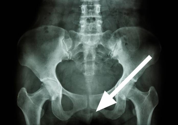 Röntgenbild Steißbeinbruch
