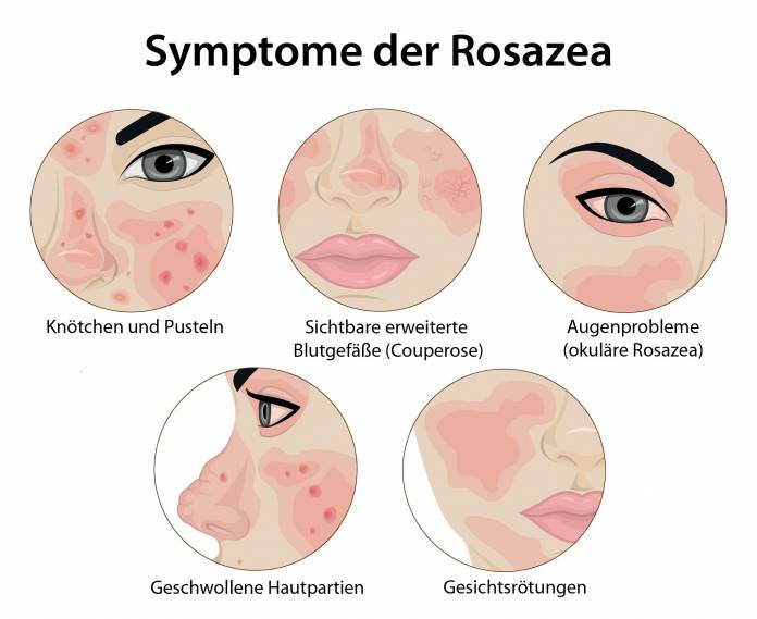 Symptome der Rosazea