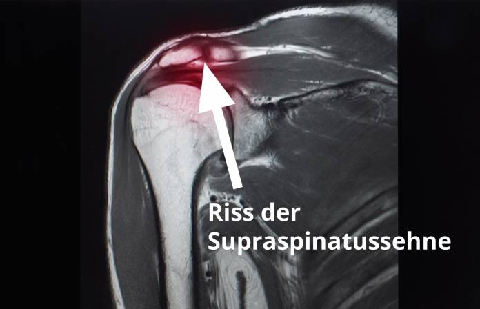 Rotatorenmanschettenriss