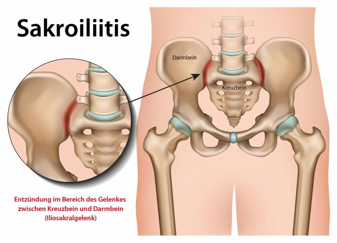 Sakroiliitis