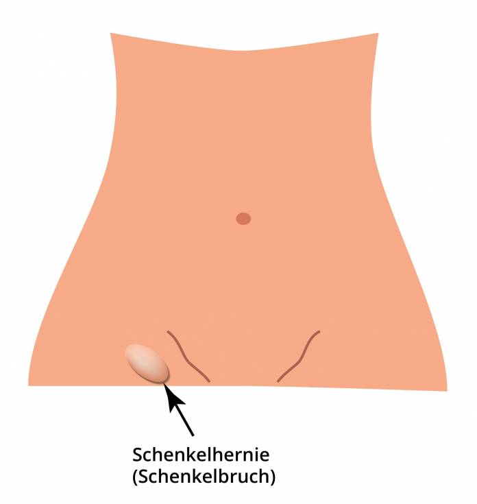 Schenkelhernie