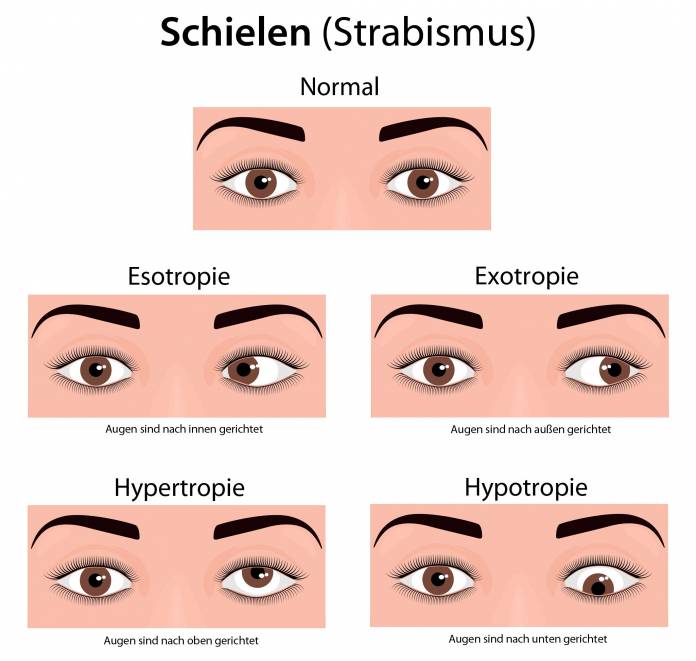 Formen des Schielens (Strabismus)