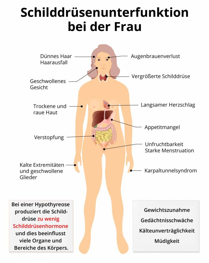 Schilddrüsenunterfunktion bei der Frau