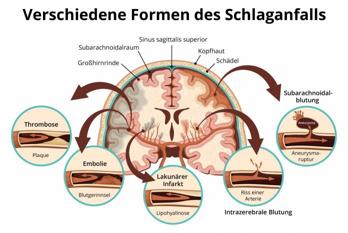 Schlaganfall Subarachnoidalblutung