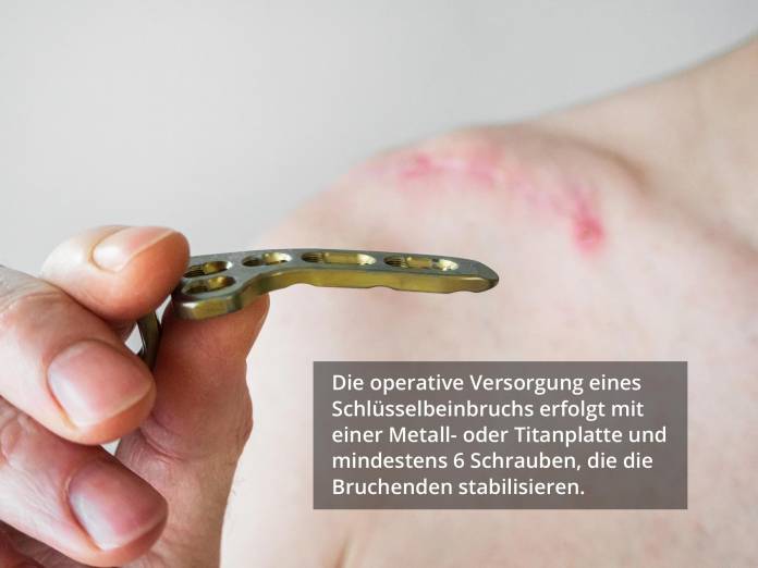 Schlüsselbeinbruch-OP