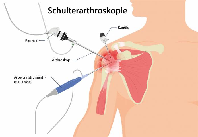 Schulterarthroskopie