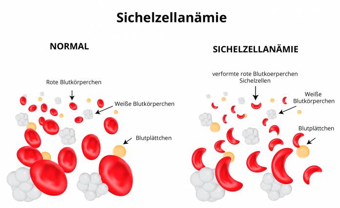 Sichelzellanämie