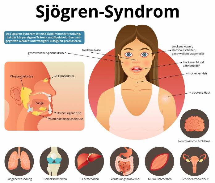 Symptome des Sjögren-Syndroms
