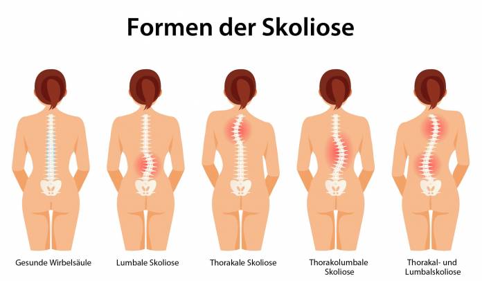 Formen der Skoliose