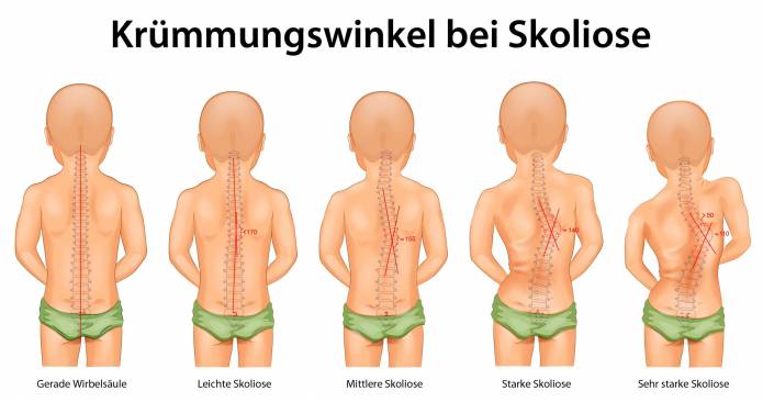 Krümmungswinkel bei Skoliose