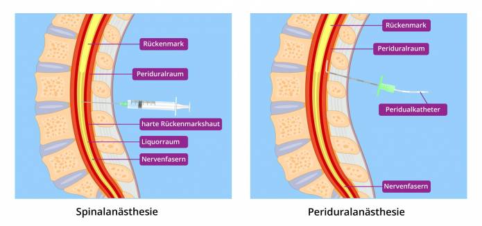 Spinalanästhesie und Peridualanästhesie