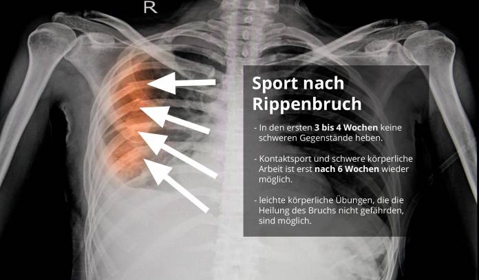 Sport nach Rippenbruch