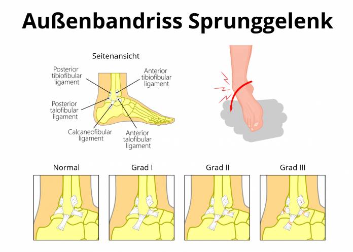 Außenbandriss Sprunggelenk