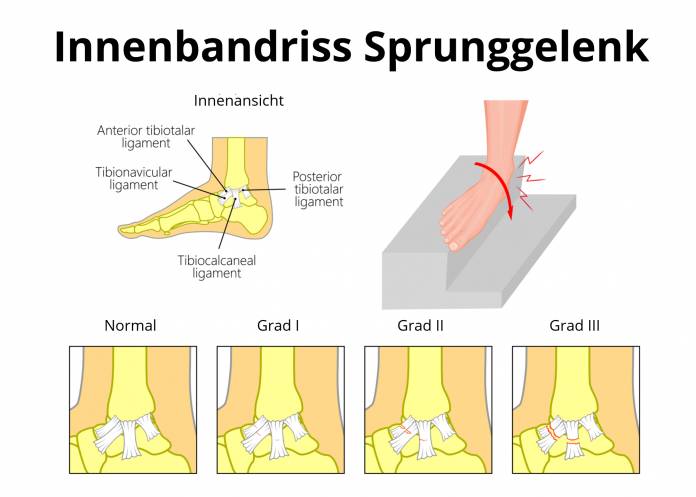 Innenbandriss am Sprunggelenk