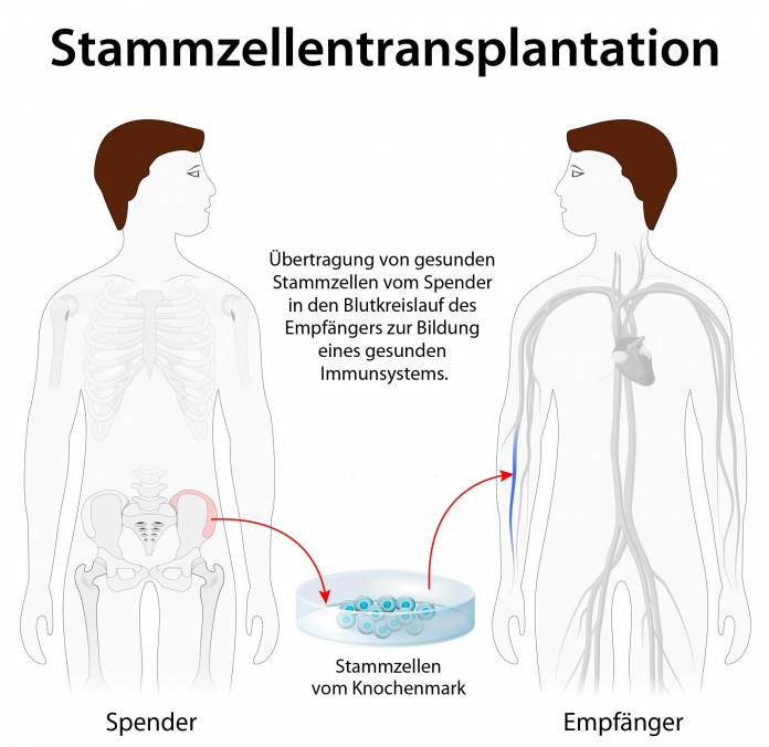 Stammzellentransplantation