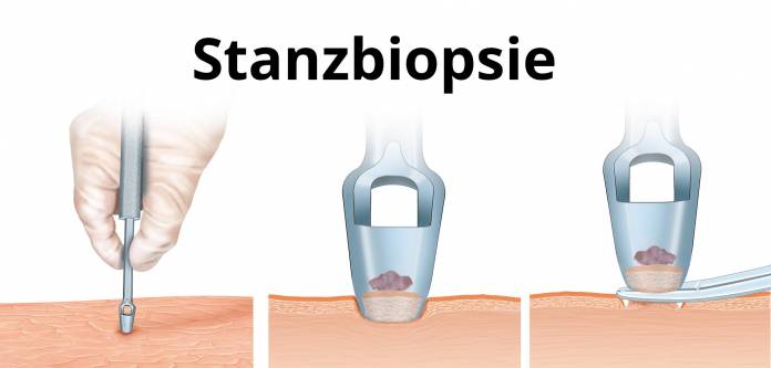 Stanzbiopsie