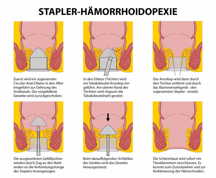 Stapler-Hämorrhoidopexie