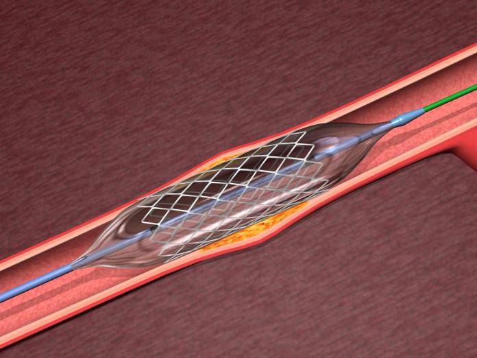 Herzkranzgefäß mit Stent