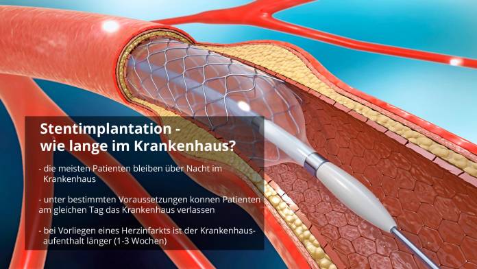 Stentimplantation - Dauer des Krankenhausaufenthalts