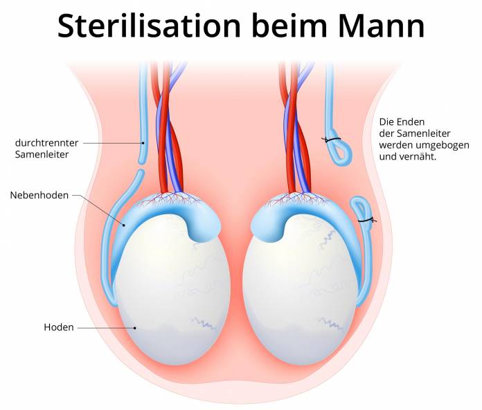 Sterilisation beim Mann (Vasektomie)