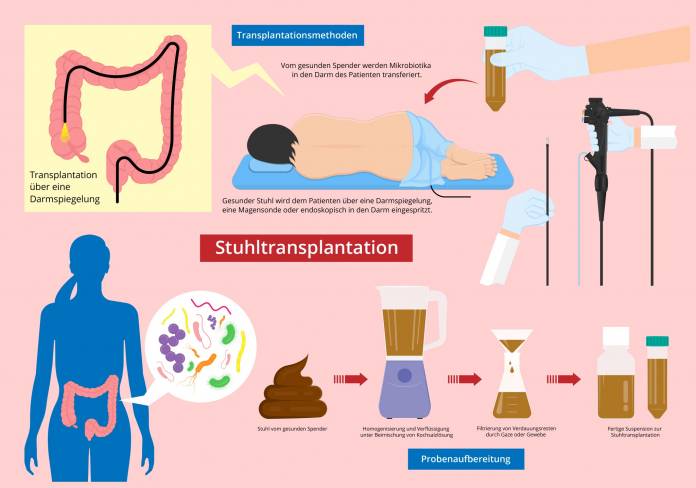 Ablauf einer Stuhltransplantation