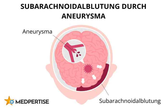 Subarachnoidalblutung durch Aneurysma