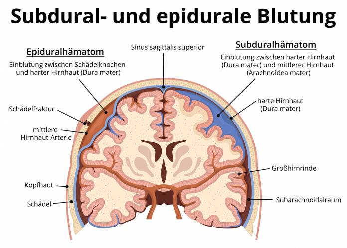 Subdural- und epidurale Blutung