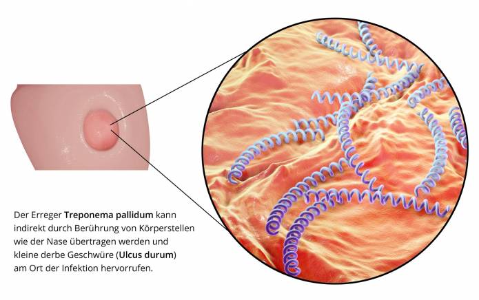 Syphilis Erreger