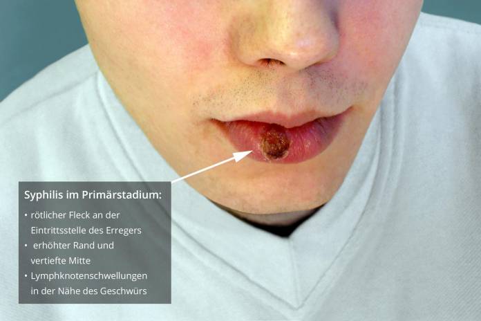 Syphilis Symptome Primärstadium