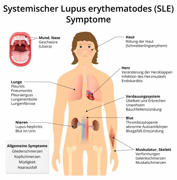 Symptome Systemischer Lupus Erythematodes