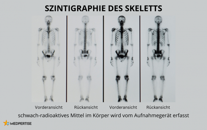 Szintigraphie des Skeletts