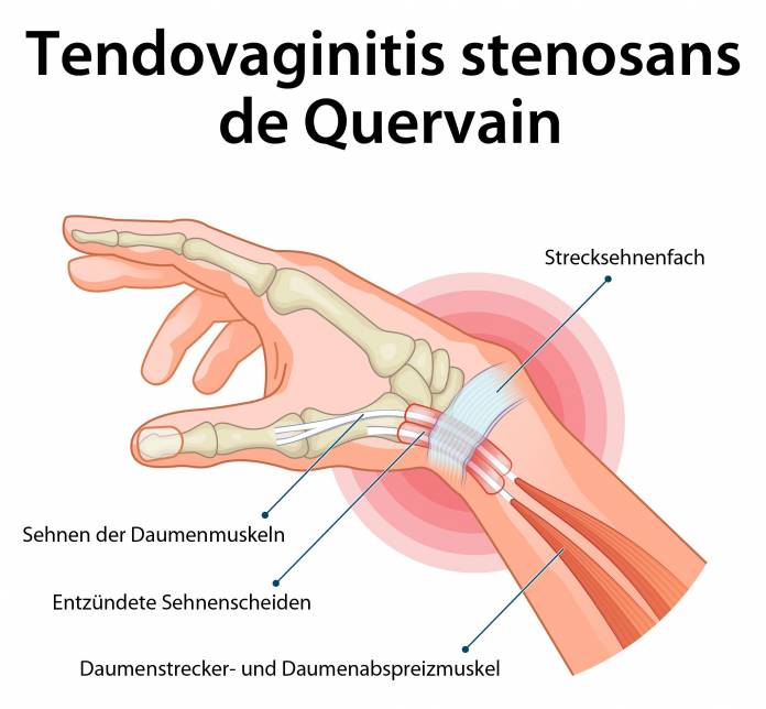 Tendovaginitis stenosans de Quervain