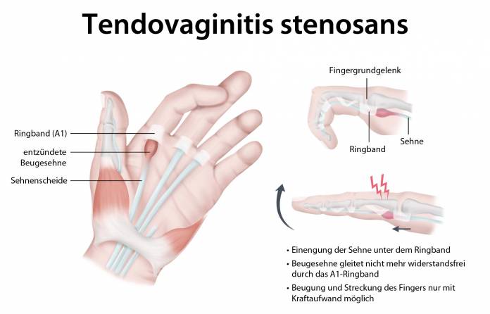 Tendovaginitis stenosans