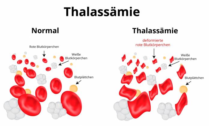 Thalassämie