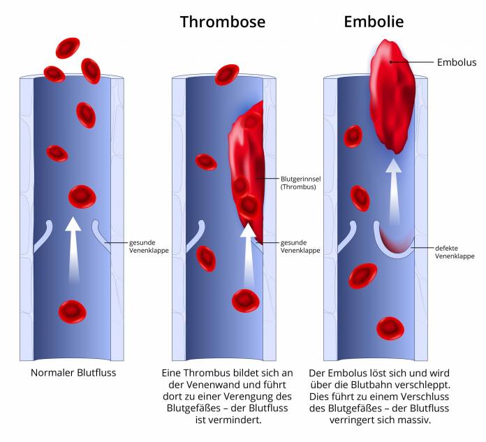 Entstehung einer Thrombose und einer Embolie