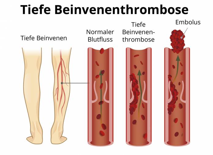 Tiefe Beinvenenthrombose