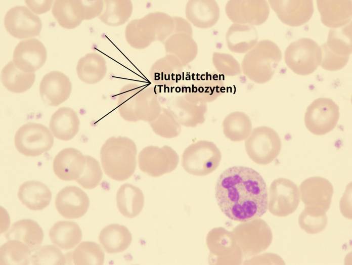 Thrombozyten zu hoch - unter dem Mikroskop