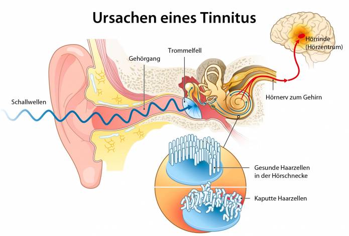 Ursachen eines Tinnitus