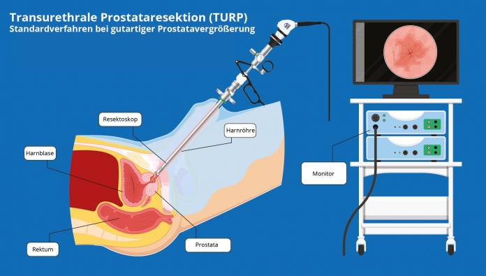 Transurethrale Prostataresektion TURP