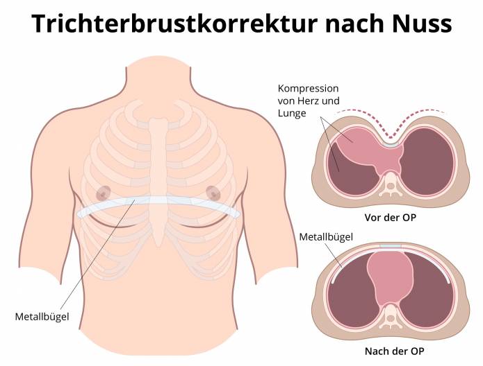 Trichterbrust-OP nach Nuss