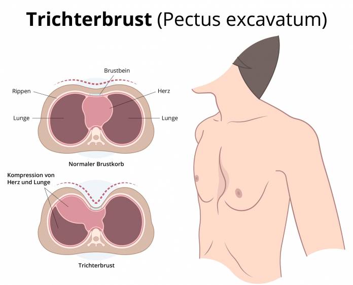 Trichterbrust