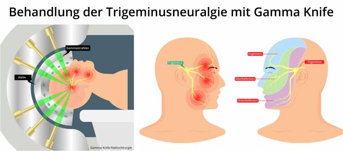 Trigeminusneuralgie Gamma Knife