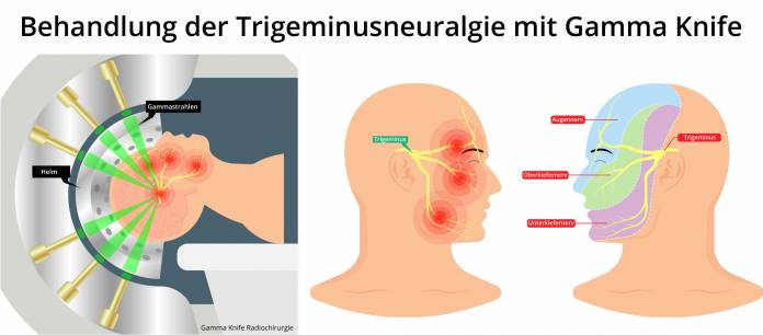 Trigeminusneuralgie Gamma Knife