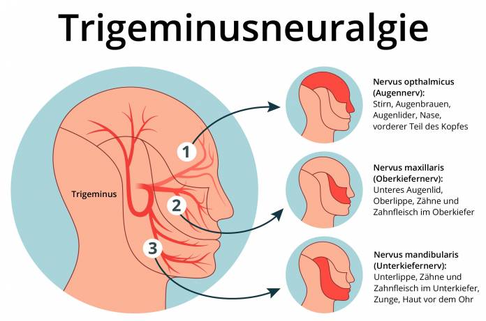 Trigeminusneuralgie