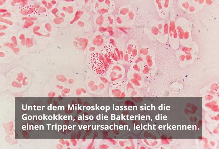 Tripper unter dem Mikroskop (Gonokkoken)