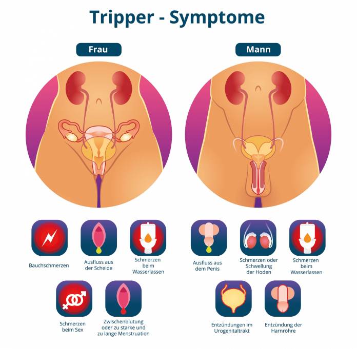 Symtome beim Tripper