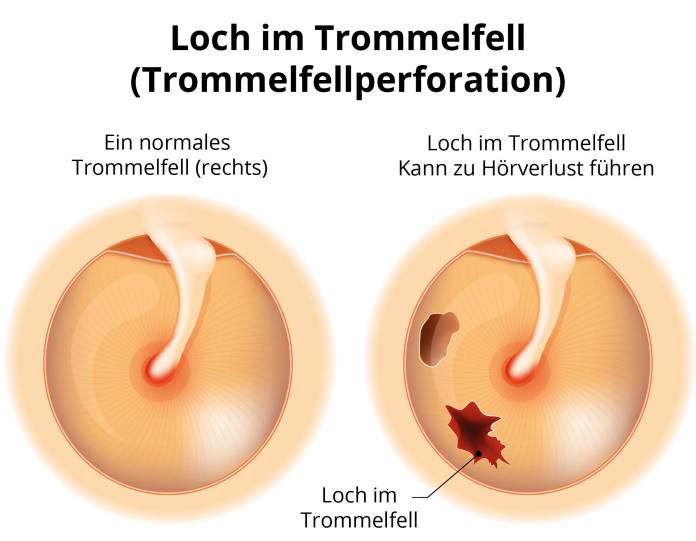 Trommelfellperforation